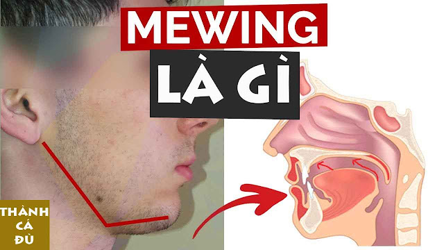 mewing là gì