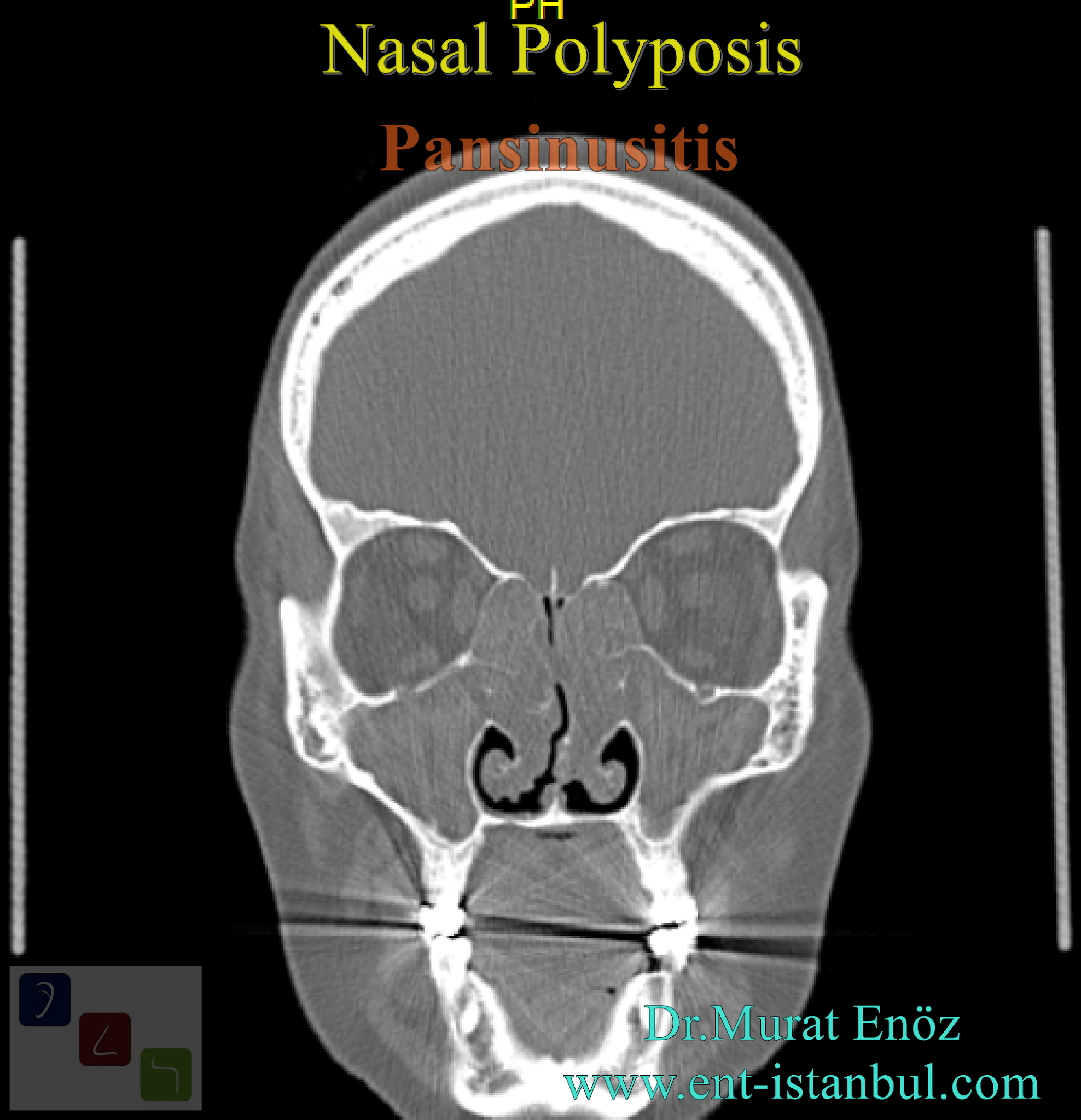 Nasal Polyp Definition, Symptoms, Diagnosis and Treatment