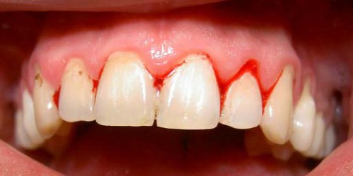 chảy máu chân răng khi đánh răng chảy máu chân răng khi đánh răng