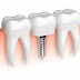 Chi phí trồng răng implant hết bao nhiêu tiền ?