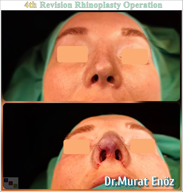 Fourth Revision Nose Job 4th Revision, Rhinoplasty Operation in Istanbul, Micromotor Assisted Revision Nose Aesthetic Surgery