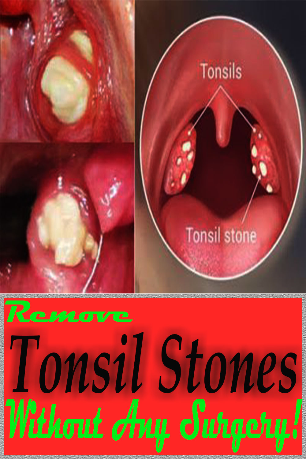 Remove Tonsil Stones Without Any Surgery!