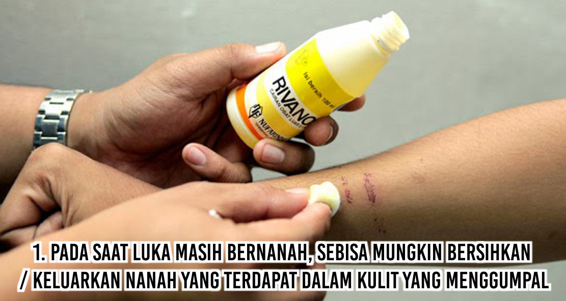 Tips Mengeringkan Luka Dalam Waktu 3 Hari Barang Promosi Mug Promosi Payung Promosi Pulpen Promosi Jam Promosi Topi Promosi Tali Nametag