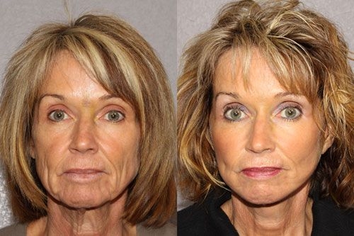 face exercises facial facelift homemade chipmunk obtain cheekbones own ways cheek neck workouts cheeks regimens nurture gymnastics using