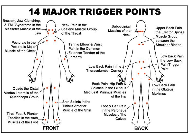 Fibro Files Myofascial Trigger Points in chronic muscle pain Causes