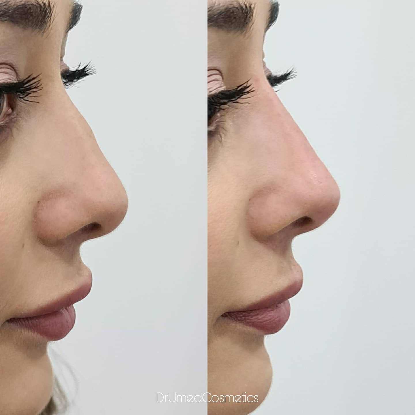 Lip Filler Guide What are Lip Filler? How long do lip fillers last?