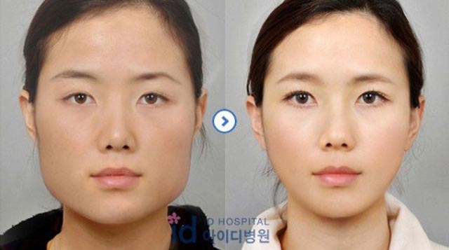 Surcoreanos antes y después cirugía plástica intensiva