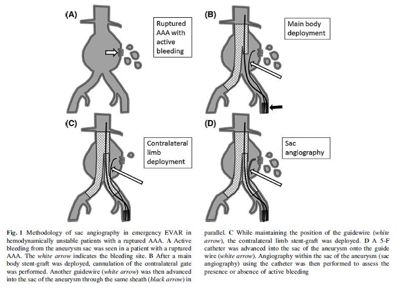 Vascular Mind SAC ANGIOGRAPHY AND GLUE EMBOLIZATION IN EMERGENCY EVAR
