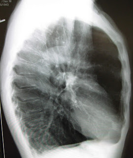 Amfizemli bir hastanın yan akciğer grafisi