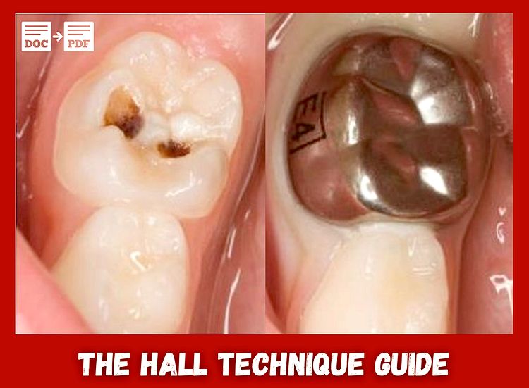 PDF THE HALL TECHNIQUE GUIDE A minimal intervention, child centred