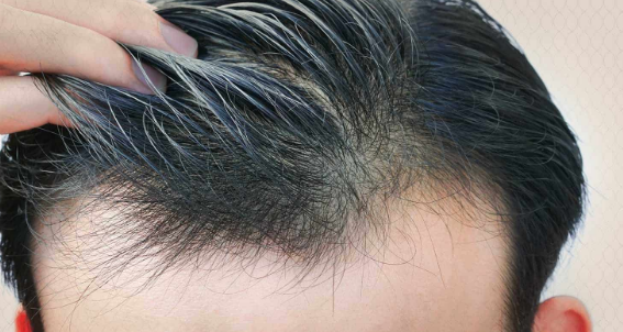 زراعة الشعر في الرياض