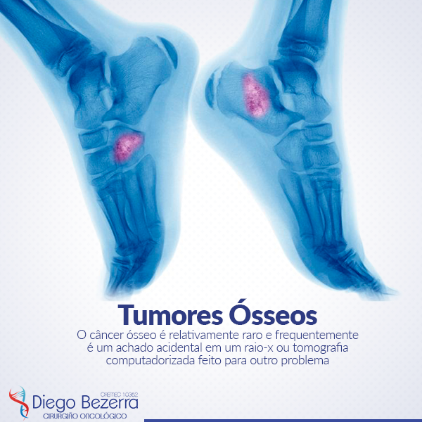 BLOG ENCONTRO COM A SAÚDE DE SOBRAL Sobre tumores ósseos Dr. Diego Bezerra (Cirurgião Geral BLOG ENCONTRO COM A SAÚDE DE SOBRAL Sobre tumores ósseos Dr. Diego Bezerra (Cirurgião Geral