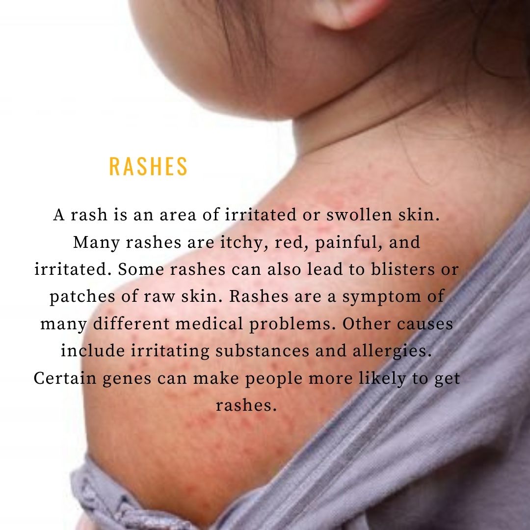 Common Causes of Skin Rashes Passions of a SAHM