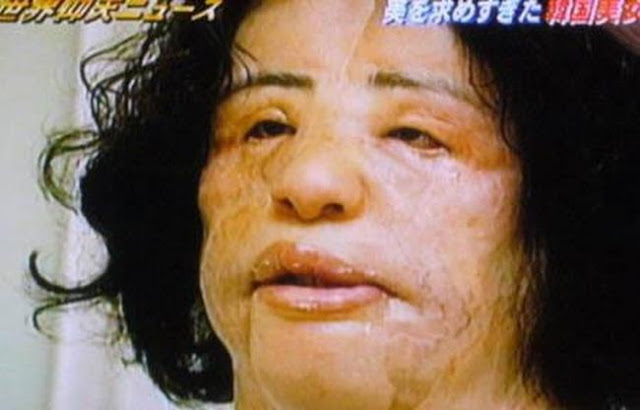 đây là 9 trường hợp phẫu thuật thẩm mỹ khủng khiếp nhất