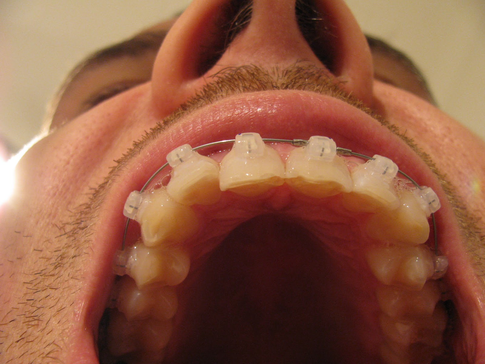 What Is A Train Track Braces? , Train Tracks Vs Invisalign Braces – BSMK