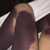 Alerta: Menina acorda com as pernas totalmente roxas sem causa aparente e mãe se desespera