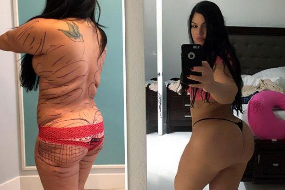 Woman has her own fat pumped into butt to get Kim Kardashian curves