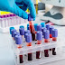 Ανατροπή: Δεν σχετίζεται η ομάδα αίματος με την πιθανότητα λοίμωξης από Covid-19