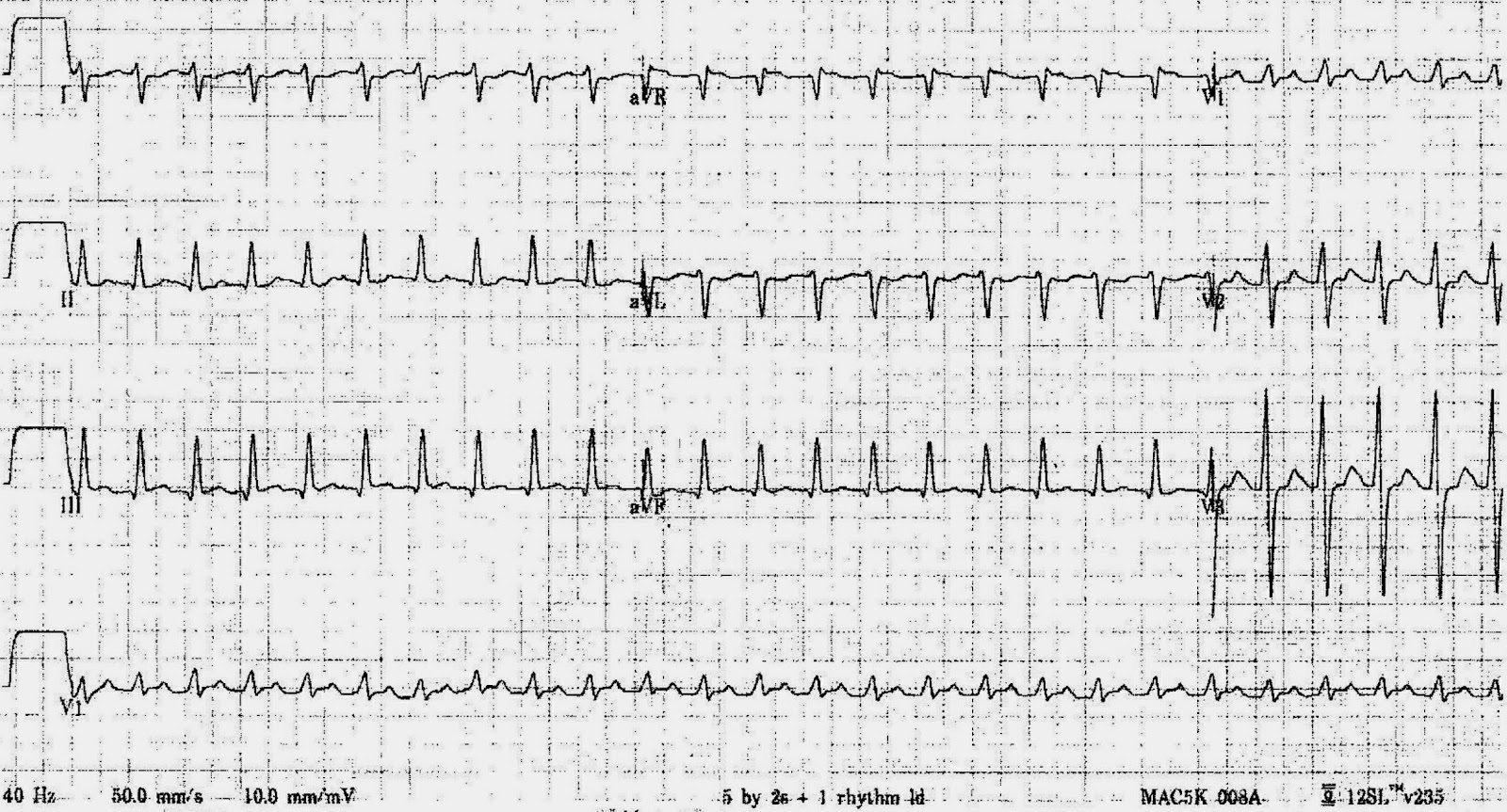 ECG of the Week ECG of the Week 20th August 2012 Interpretation
