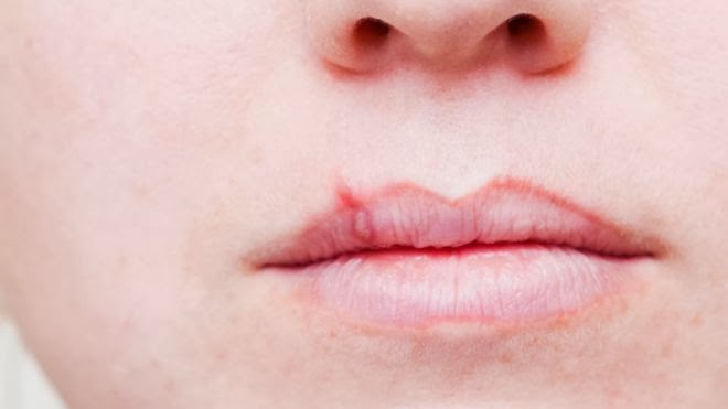 Cold Sores on Lips|Walgreens