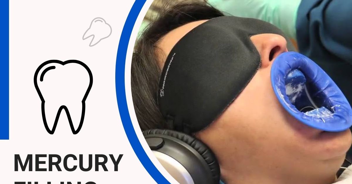 Mercury Filling Removal