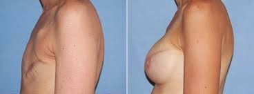 http://cancer-treatment-madurai.com/breast-cancer-ldflap-surgery.php