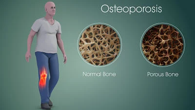 Aprueban medicamentos que produce hueso para la Osteoporosis