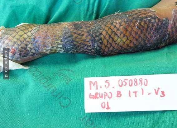 Wanita Ini Menderita Luka Bakar Yang Sangat Serius Kemudian Dokter Menempelkan Sisik Ikan Di Atas Luka Dan Keajaiban Pun Terjadi Klik Share