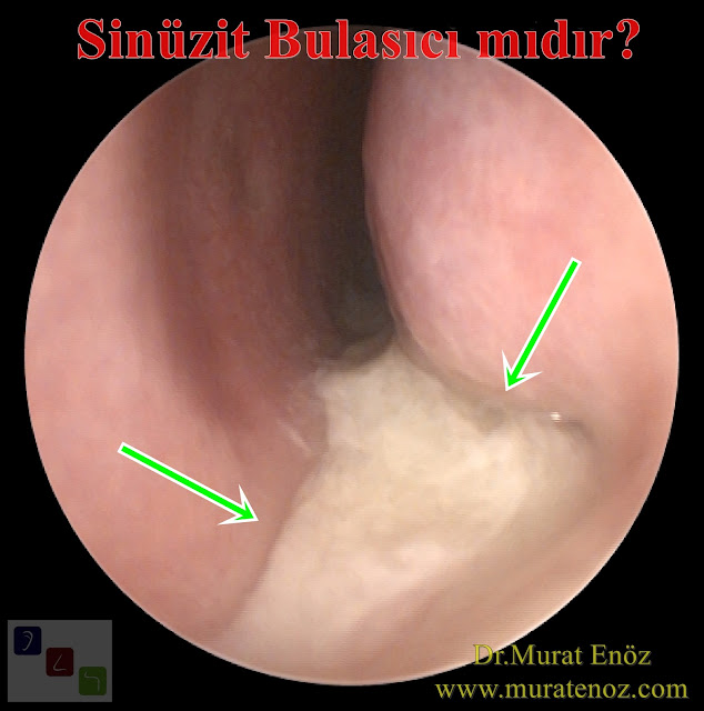 Are Sinus Infections Contagious? - Is A Sinus Infection Contagious? - How is sinusitis transmitted?