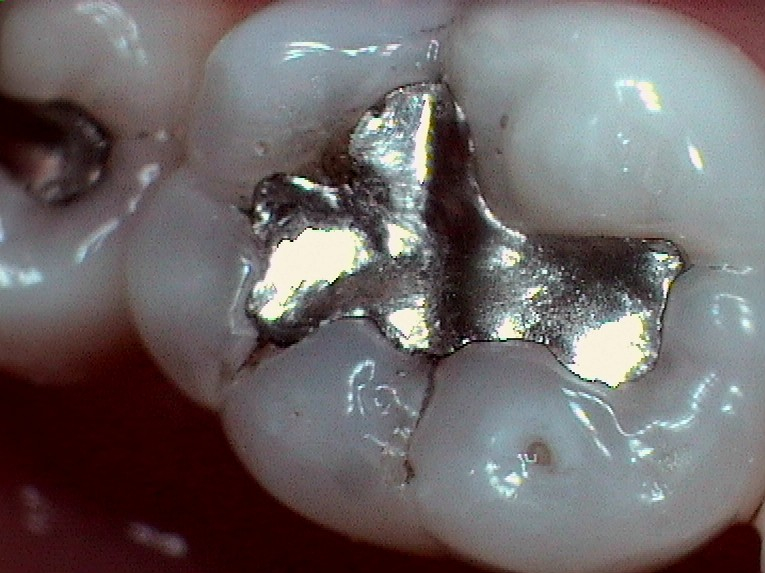 Crabapple Dental Before and After Porcelain Restorations