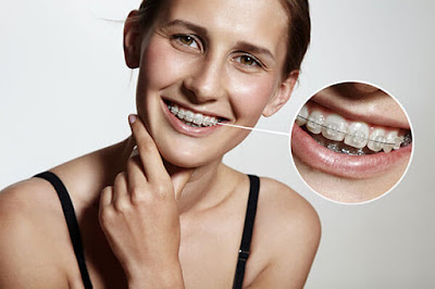  Các loại mắc cài niềng răng phổ biến 
