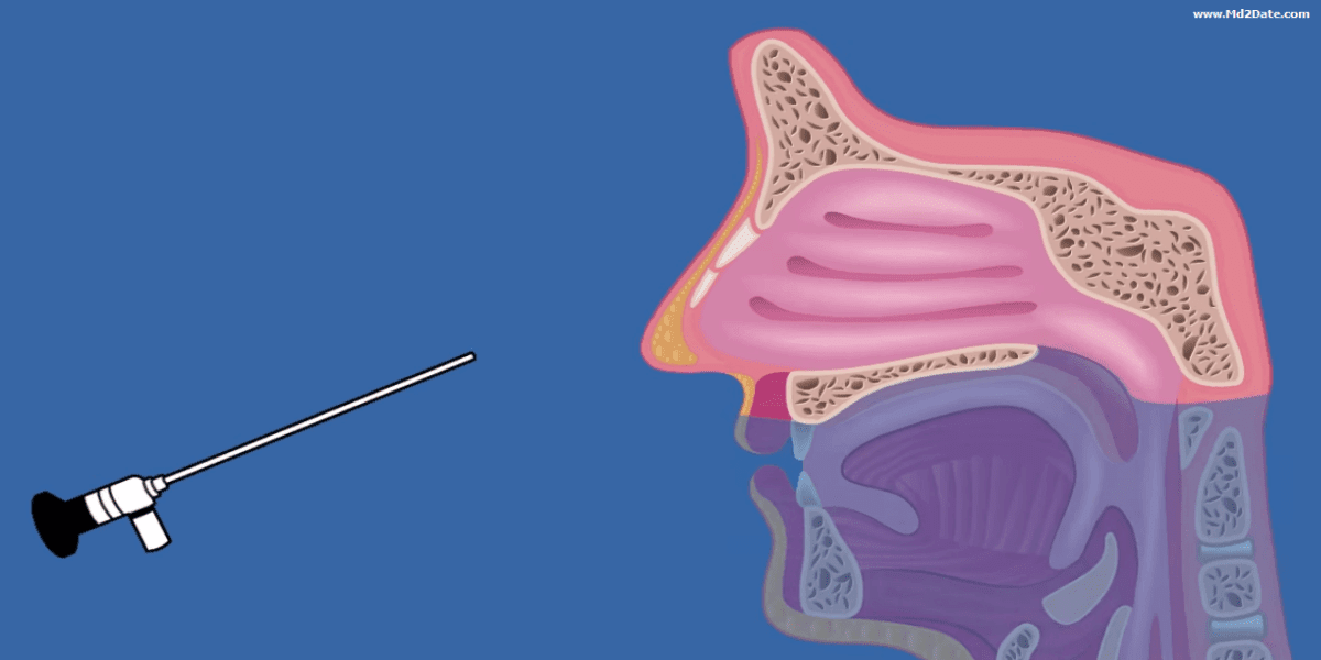 Nasal Endoscopy and FESS maneuver, indications, aims, complications