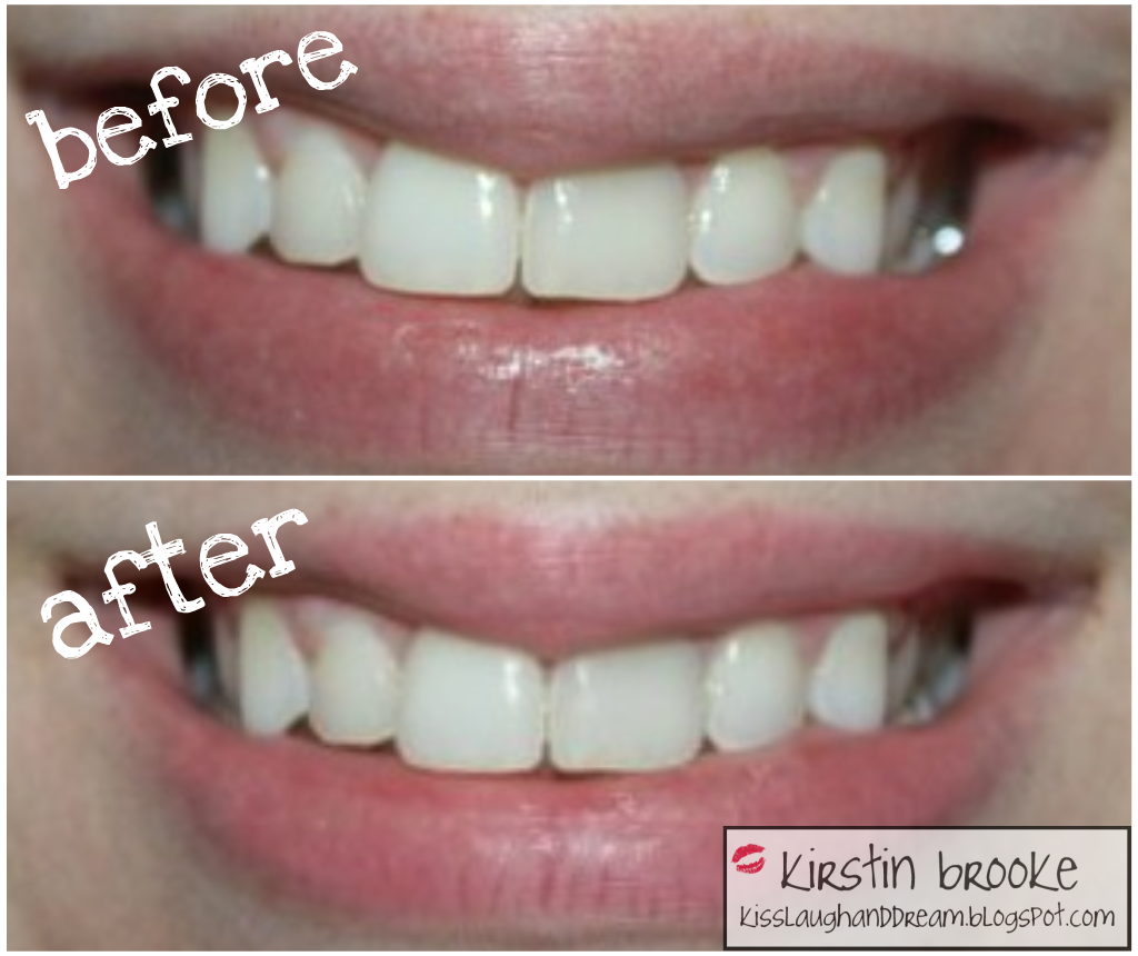 Elly hay How to keep teeth white after whitening