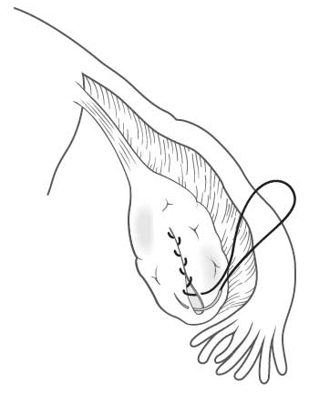 Ovarian Cystectomy surgery