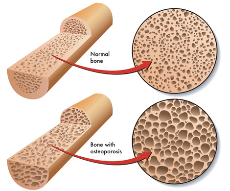 Osteoporosis bone