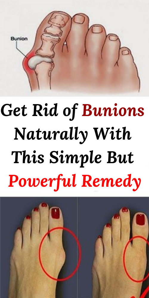 Get Rid of Bunions Naturally With This Simple But Powerful Remedy