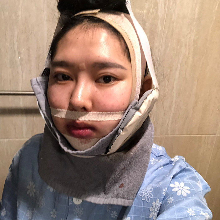 Double Jaw & Vline Surgery Post OP 1 Month