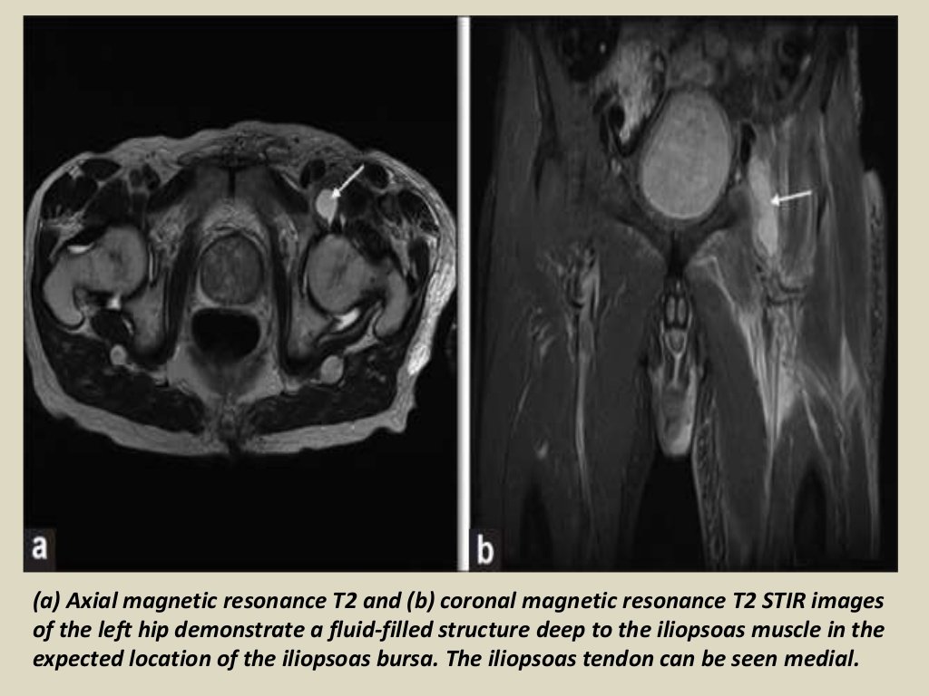 MRI MusculoSkeletal Section Bursa of hip joint.