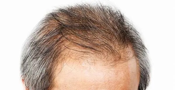 mayor terapia; perdida del pelo ; caida del cabello; caida del pelo ; perdida del cabello para hombres; perdida del cabello para mujers