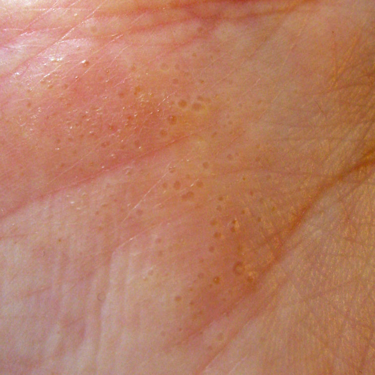 small itchy bumps on hands #11