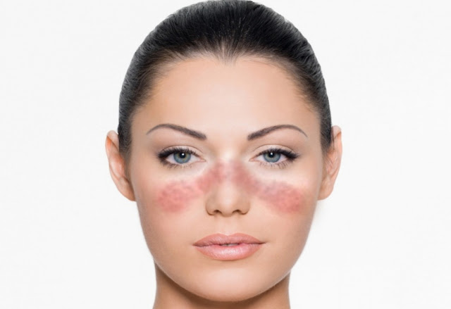 how do you get lupus is lupus contagious how do you get lupus is lupus contagious