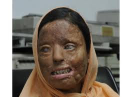woman with burned skin because of acid attack in India