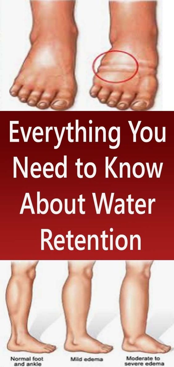 Everything You Need to Know About Water Retention Nutrition Health Tips