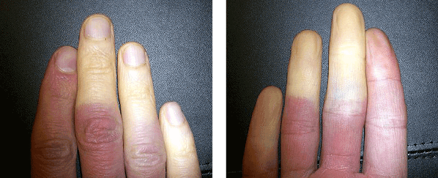 Болезнь Рейно: симптомы, диагностика и лечение