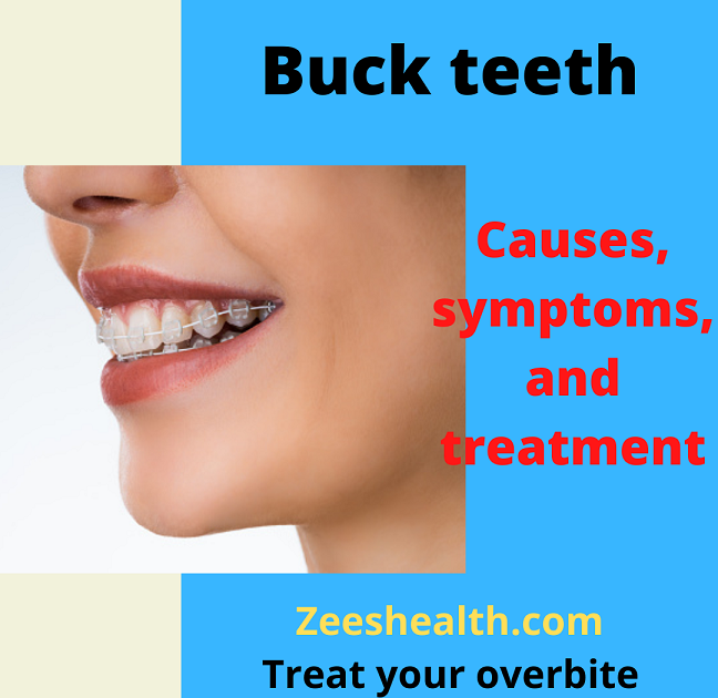 Buck teeth Causes, risks, and treatment for an overbite Zeeshealth
