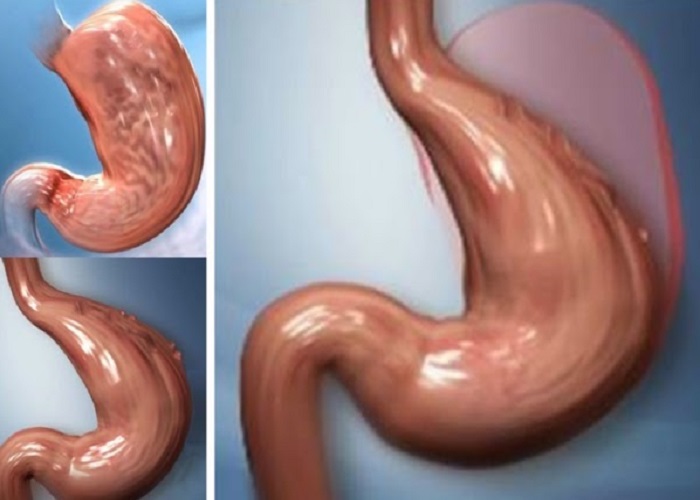 Redução de Estômago Já Pode Ser Usada Para Tratar Diabetes - Saúde