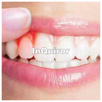 أسباب التهاب اللثة وطرق الوقاية لتجنب مضاعفاتها أسباب التهاب اللثة وطرق الوقاية لتجنب مضاعفاتها