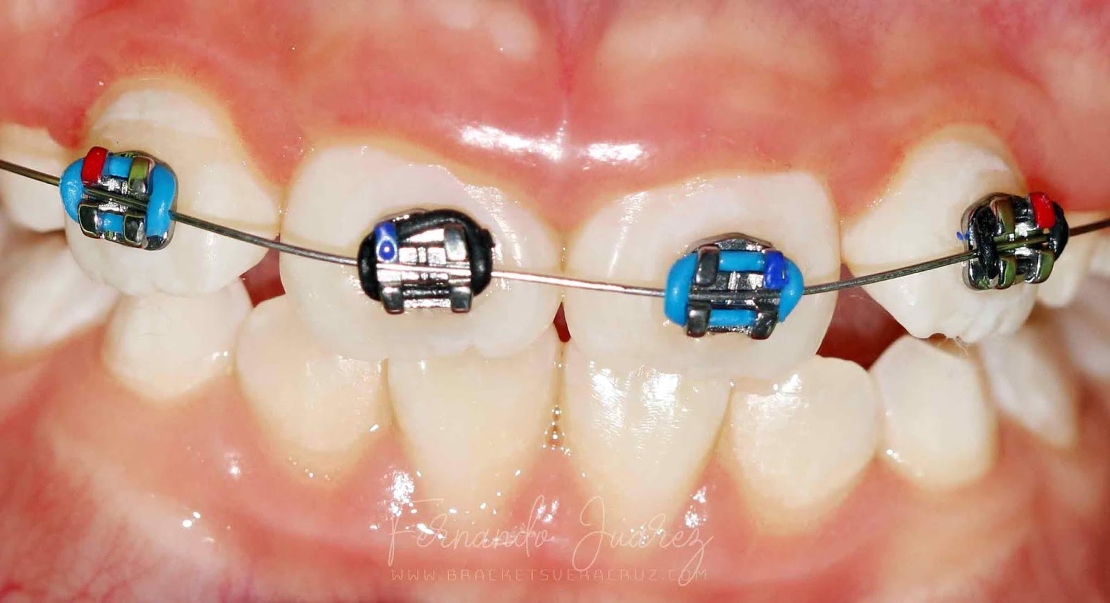 ¿A qué edad puedo comenzar a usar brackets? Brackets Veracruz