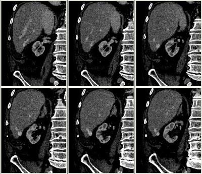 Intrahepaticus veno-venosus malformatio