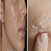 Home Remedies To Remove Dark Pimple Marks At Once